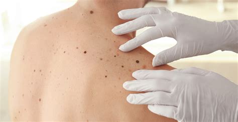 melanoma skin treatment